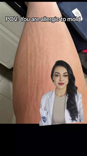 78K views · 776 reactions | If you have a rash caused by mold exposure, it’s important to remove yourself from the source of the mold to prevent further reactions. ✅️Home remedies may also help alleviate your itchy rash | Dr. Mehss | Facebook