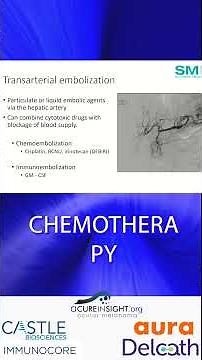 How Does Hepzato Deliver Targeted Chemotherapy to the Liver #histotripsy #livercancertreatment
