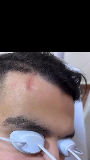 418 reactions · 29 shares | Traitement des cicatrices au laser CO2 #laser #laserco2 #drzamouchedermatocheraga #cicatricesacné | Dermatologue Cheraga - Dr. ZAMOUCHE | Facebook