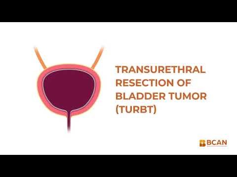 TURBT for Bladder Cancer: What It Is and How It Works