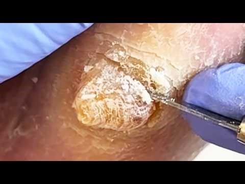 A Huge Callus On My Foot, Very Dry, Needs Thorough Treatment!【Podiatry Clinic】