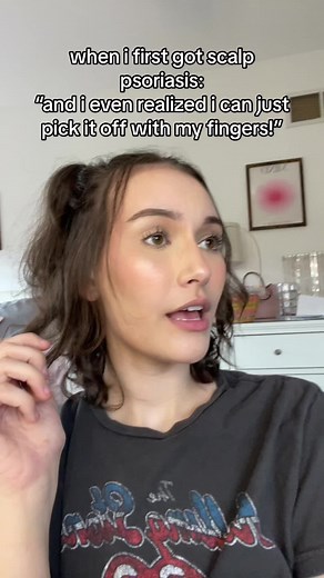 Scalp Psoriasis Removal and Management