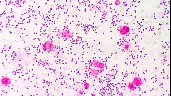 Neisseria gonorrhoeae, a species of Gram-negative diplococci bacteria. It causes the sexually transmitted genitourinary infection gonorrhea