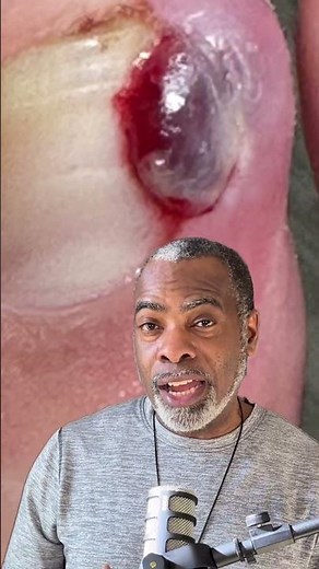 Granuloma #podiatry #granuloma #ingrowntoenail