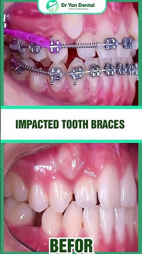 Impacted tooth braces #braces #dryan