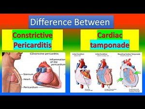 Difference Between Constrictive Pericarditis and Cardiac Tamponade