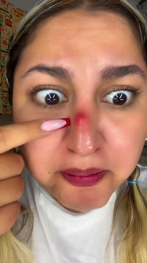 Cómo quitar ese grano en la nariz fácilmente