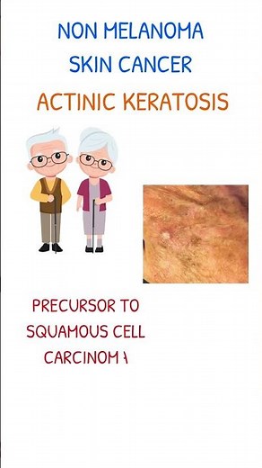 ACTINIC KERATOSIS SKIN CANCER