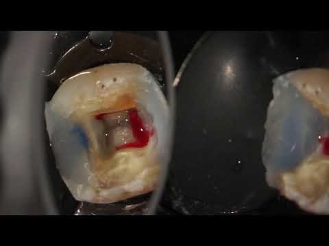 Complete endodontic treatment of a lower first molar step by step.