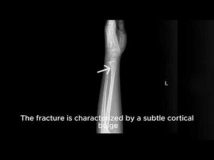 Torus Fracture