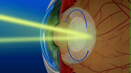 Operación de cataratas