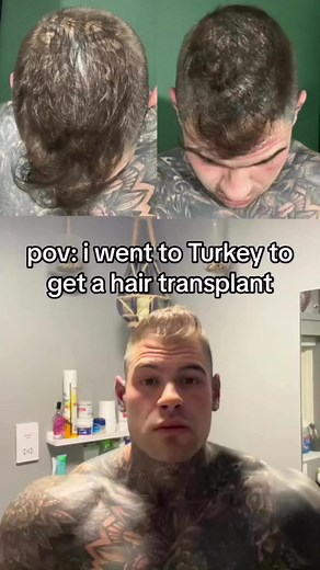 42K views · 59 reactions | Back in October I went to Turkey to have my hair transplant. This procedure is a process and takes months to see the results. Now, 5 months later, I can show you guys the results Prime Health Concept | David Chudley | Facebook