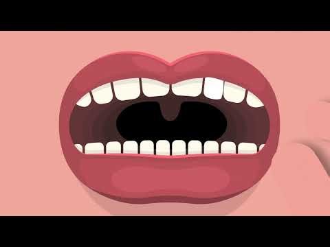 Smilogic - Temporary Tooth DIY Replacement Solution for Missing Teeth