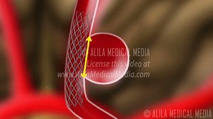 Endovascular Coiling for Brain Aneurysm, Animation. on Make a GIF