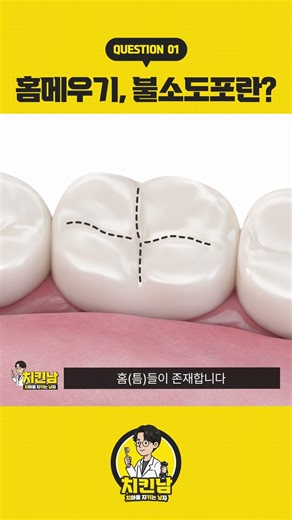 치과에만 갔다 하면 충치가?! 홈메우기, 불소도포란? 🦷✨