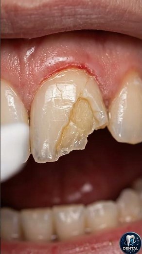 How Broken Front Teeth Are Repaired 🦷 Chipped and Cracked Tooth Restoration Explained