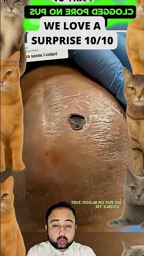 Large Blackheads Extraction Big Cystic Acne Blackheads&Whiteheads Removal Pimple Popping #1136 2026