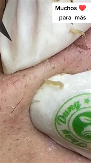 Effective Tick Removal Techniques for Your Skin