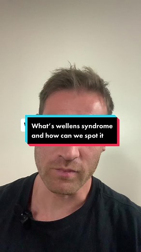 Understanding Wellens Syndrome: Spotting Abnormal T Wave Versions