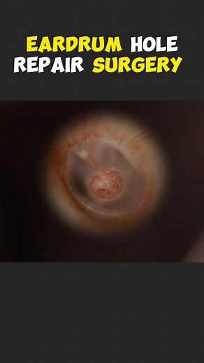 Eardrum Hole Repair Surgery 3D Animation #eardrumhole #earsurgery #eardrumsurgery #eardrumrepair #eardrumruptured #eardrumrupture #ent #entsurgery #entsurgeon? #medical3danimation #3dmedicalanimation #medicalprocedure #tympanoplasty #tympanoplastysurgery #tympanoplastywithmastoidectomy #tympanoplastie