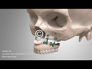 Corrective Jaw Surgery Orthognathic