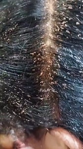 85K views · 468 reactions | Here are some of the dangers of head lice...