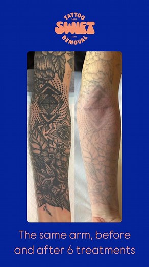 Before and After Tattoo Removal Results Explained