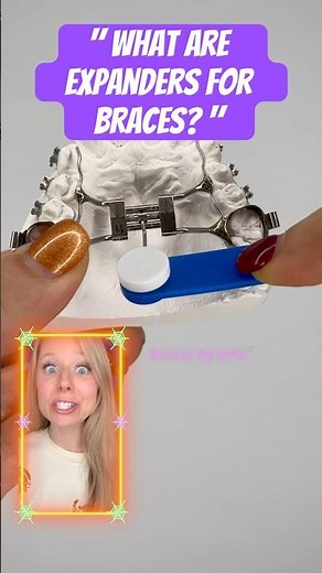 What are EXPANDERS FOR BRACES? 🧐 #braces #teeth #expander