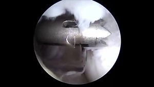Arthroscopic HAGL, Anterior, and Posterior Labral Repair