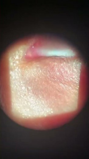 Tear duct ( punctal) plug insertion