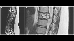 Her legs were tingling. Then, doctors pulled a tapeworm out of her spine