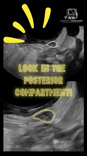 Finding & measuring uterosacral #endometriosis on #ultrasound