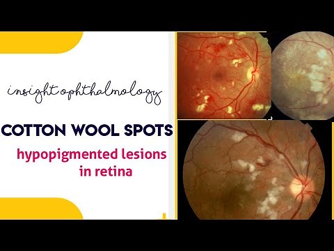 COTTON WOOL SPOTS EXPLAINED !