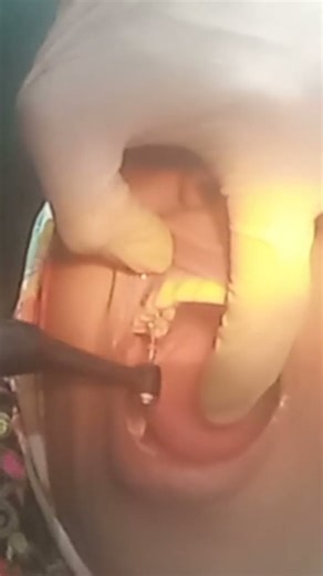 “Root Canal Step-1 | Root Opening & Cleaning | Pain Relief”