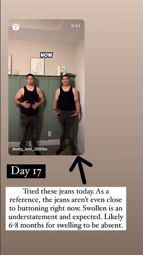 Day 17: post ￼￼￼ penectomy #looseskin