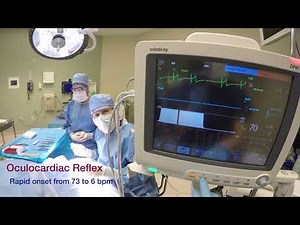 Oculocardiac reflex