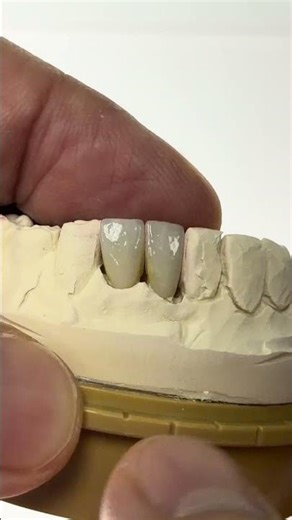 Layered Monet Pure zirconia crowns for Dr. Young H. Kim in Illinois