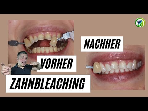 Vorher- nachher, Bleaching - Zahnaufhellung, Ablauf, Kosten, Erfahrung