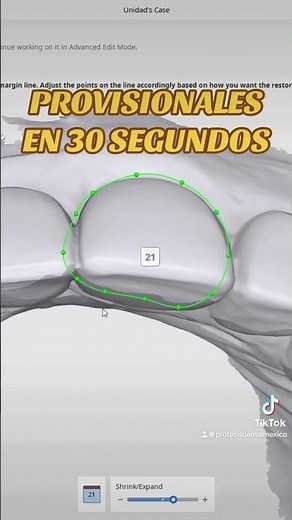Provisionales en 30 segundos #dentalcad #protesisdental #dentaldesign #cadcamdental #dentalcad
