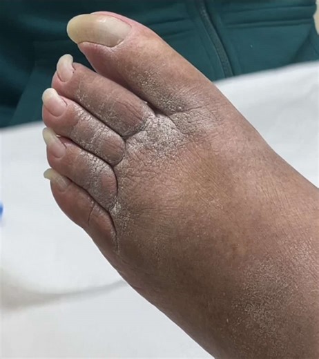 Essential Toenail Care: Trimming Overgrown Nails