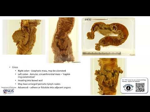Colon: Adenocarcinoma (Gross Pathology)