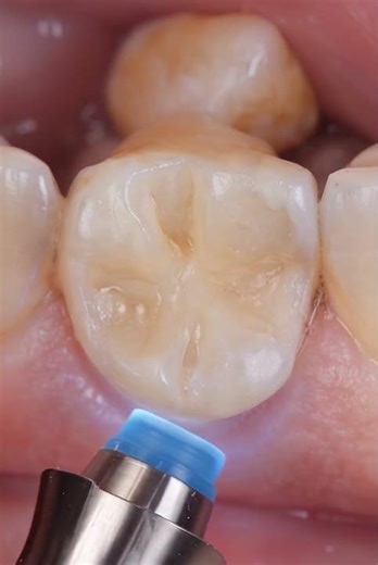 Acid Washed Teeth 😱 Enamel Erosion Repair & Natural Smile Restoration