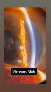 Vitreous Blob | Dr-Muzamil Hussain Baloch