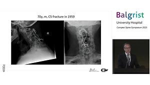 Cervical Corpectomy and En Bloc Resection