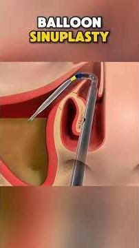 How is sinus surgery performed and what are its benefits?