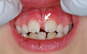 Frenectomia: Indicaciones y Precios en Lima Perú| Solución Dental