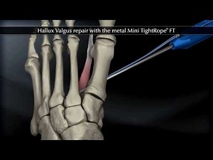 Mini Tight Rope Procedure