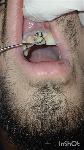 calss v composite restoration befoe retainer #dentist #satisfying