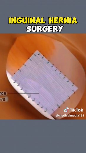 Inguinal hernia surgery medical animation 3D #inguinal #inguinalhernia #hernia #herniasurgery #hernias #medicalanimation