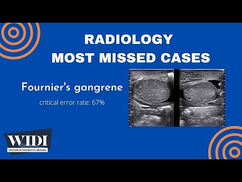 Most Missed Cases: Fournier's Gangrene